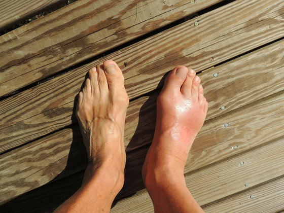 Gout & Dehydration